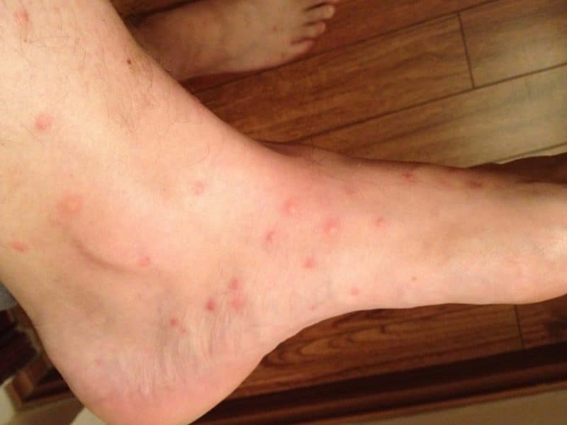 Sand fly bites on the foot