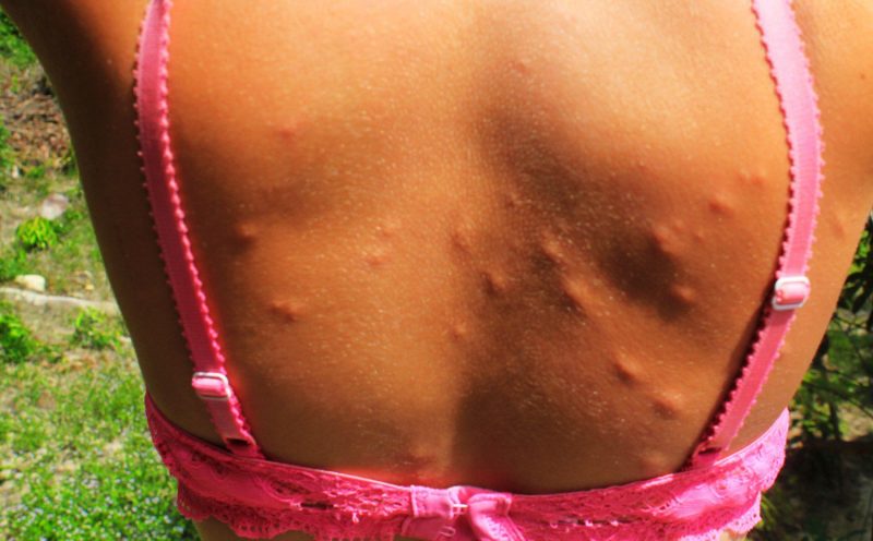 Woman bitten by sandflies in Thailand