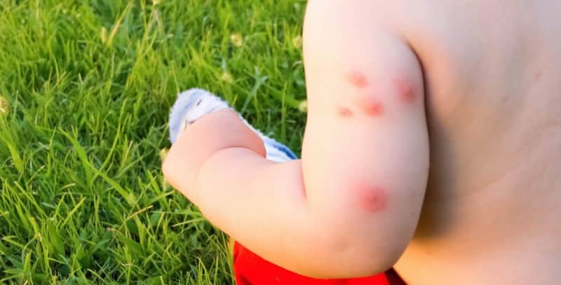 Baby with many mosquito bites