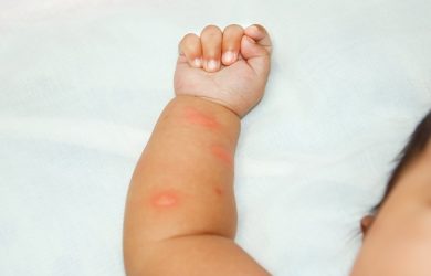 A baby with mosquito bites