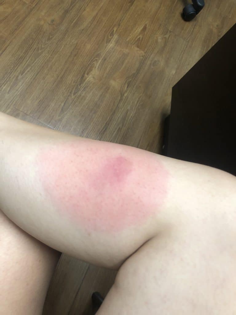 A person with an allergic reaction to a skeeter bite