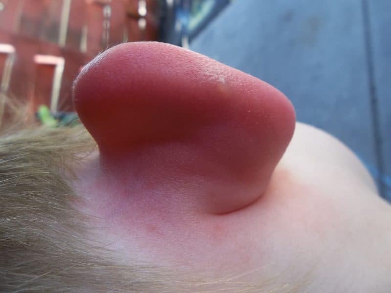 A child with skeeter syndrome