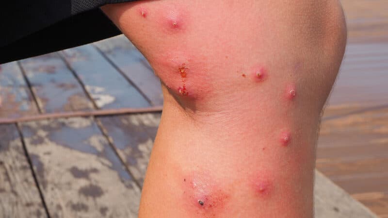 Numerous mosquito bites on a leg