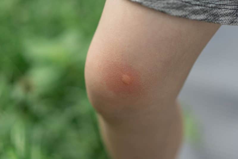 A mosquito bite on a child's leg