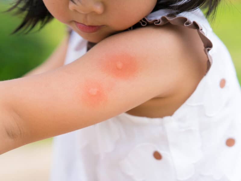 A child with potential dengue mosquito bites