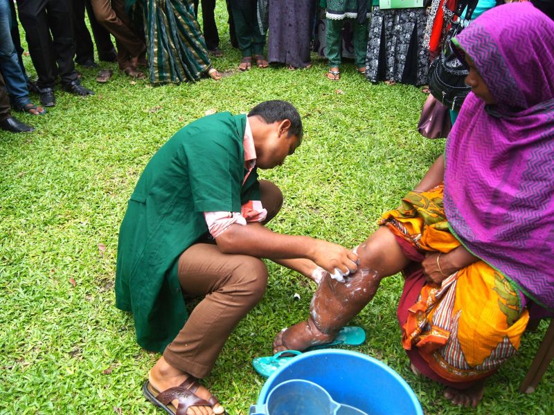Deadly mosquitoes can result in filariasis symptoms such as swelling of the limbs