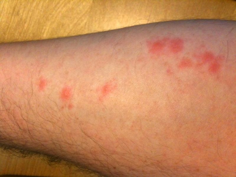 Bites from gnats look like mosquito bites