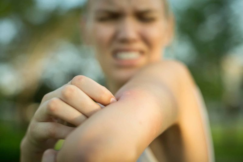 A girl bit by a female mosquito