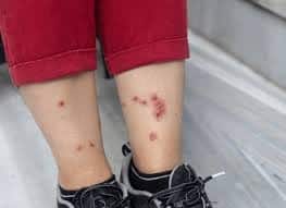 Bites from female mosquitoes can cause allergic reactions