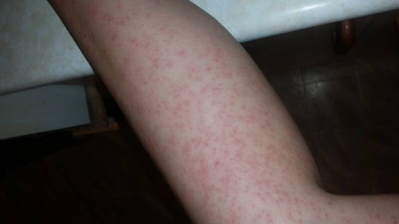 Rashes all over the arms, legs, and trunk                        