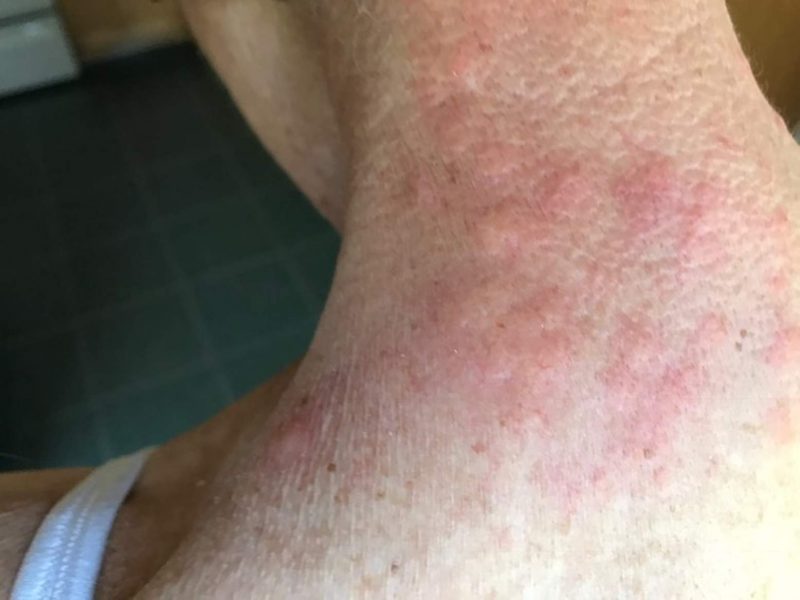 Hairy caterpillars cause this terrible skin rash
