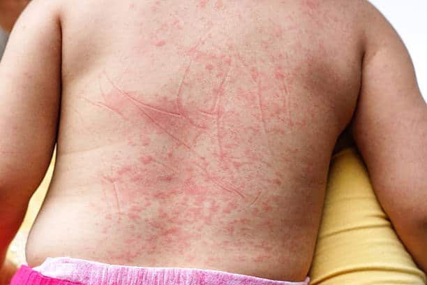 Rashes from dengue in a child with obesity